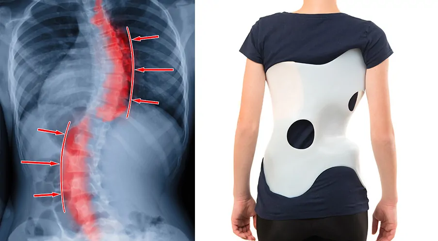 Scoliosis & Corsets: Can a Steel Boned Corset Help with Spinal Curvature?