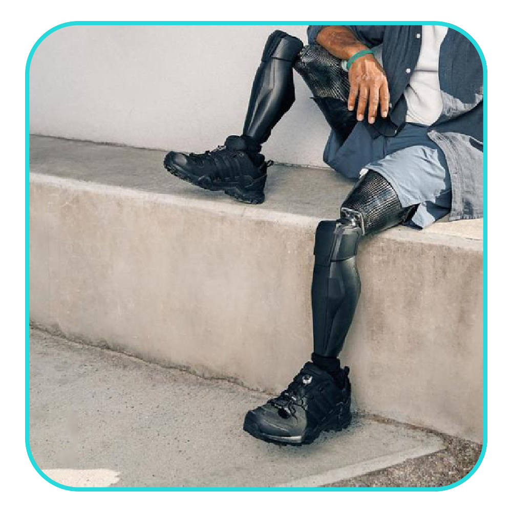 Above Knee Prosthesis - Provitalprotez - 2023