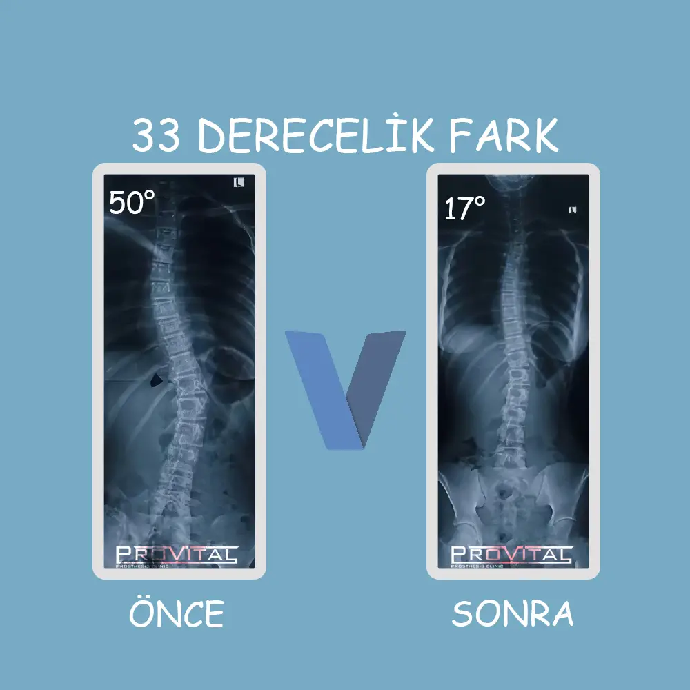 Skolyoz Korsesi Fiyatları (2025) (Skolyoz Tedavisi) 10 provital skolyoz korse