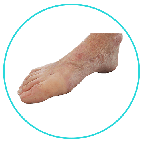 provitalprotez silikon ayak parmak protezi