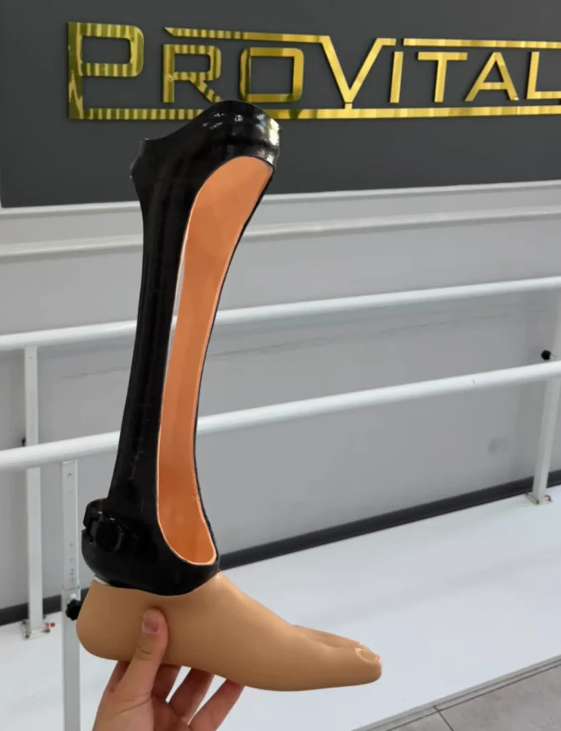 Chopart Amputasyonu ve Protez Kullanımı 7 chopart protezi