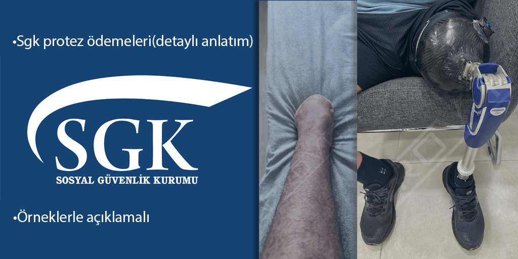 SGK Protez Ödemeleri (2025): Protez Çeşitlerine Göre Ödemeler 1 sgk protez bacak odemeleri