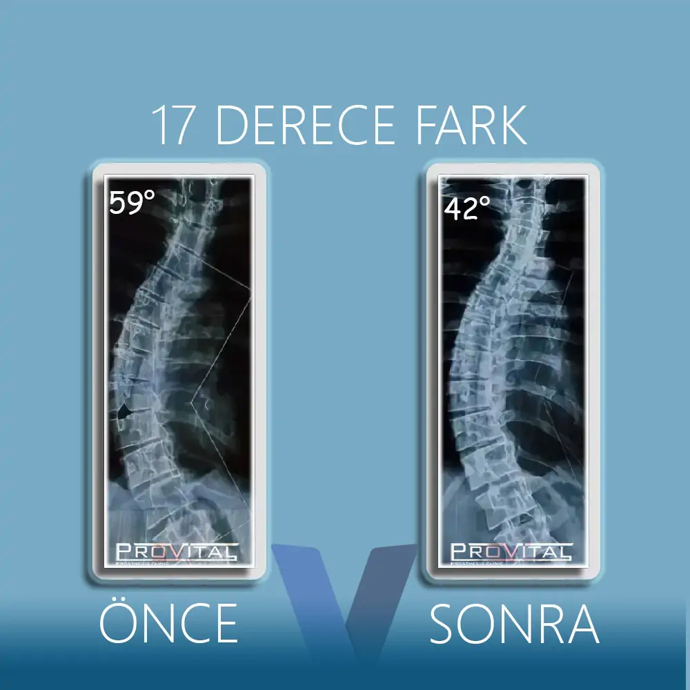 Skolyoz Korsesi (Ameliyatsız Skolyoz Tedavisi) 69 80-derece-skolyoz-görüntüsü