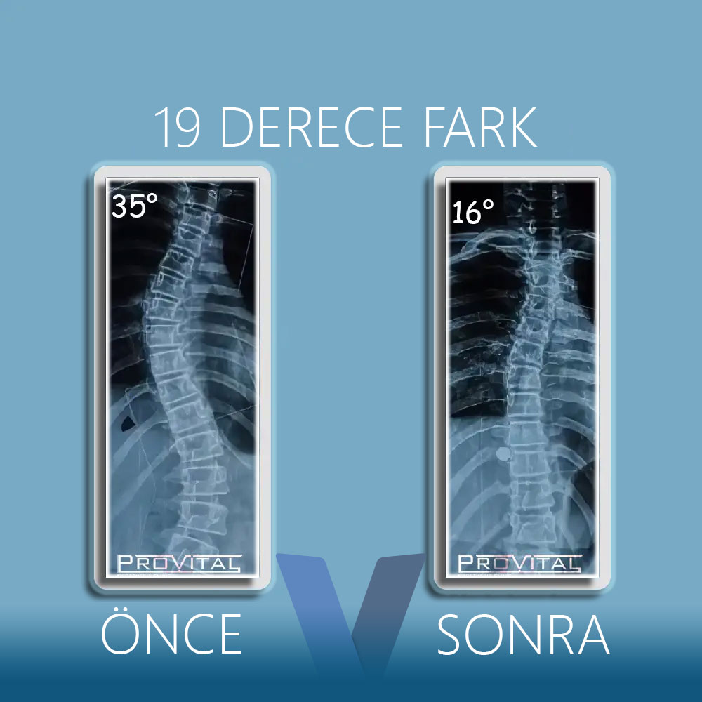 Skolyoz Korsesi Fiyatları (2025) (Skolyoz Tedavisi) 22 skolyoz-20-derece