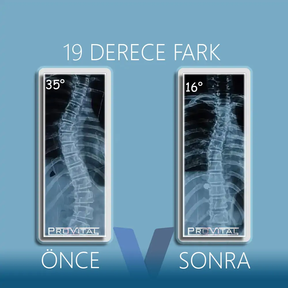 Skolyoz Korsesi (Ameliyatsız Skolyoz Tedavisi) 64 skolyoz-20-derece