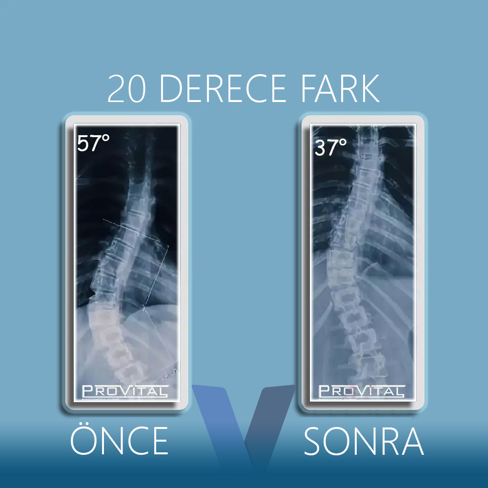 Skolyoz Korsesi Fiyatları (2025) (Skolyoz Tedavisi) 23 skolyoz-derecesi-düşer-mi