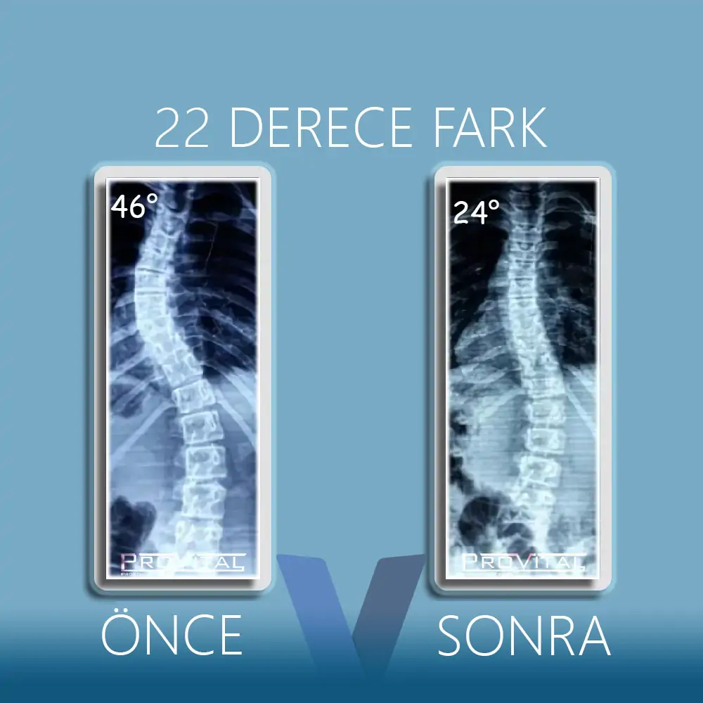 Skolyoz Korsesi (Ameliyatsız Skolyoz Tedavisi) 60 skolyoz-kaç-derece