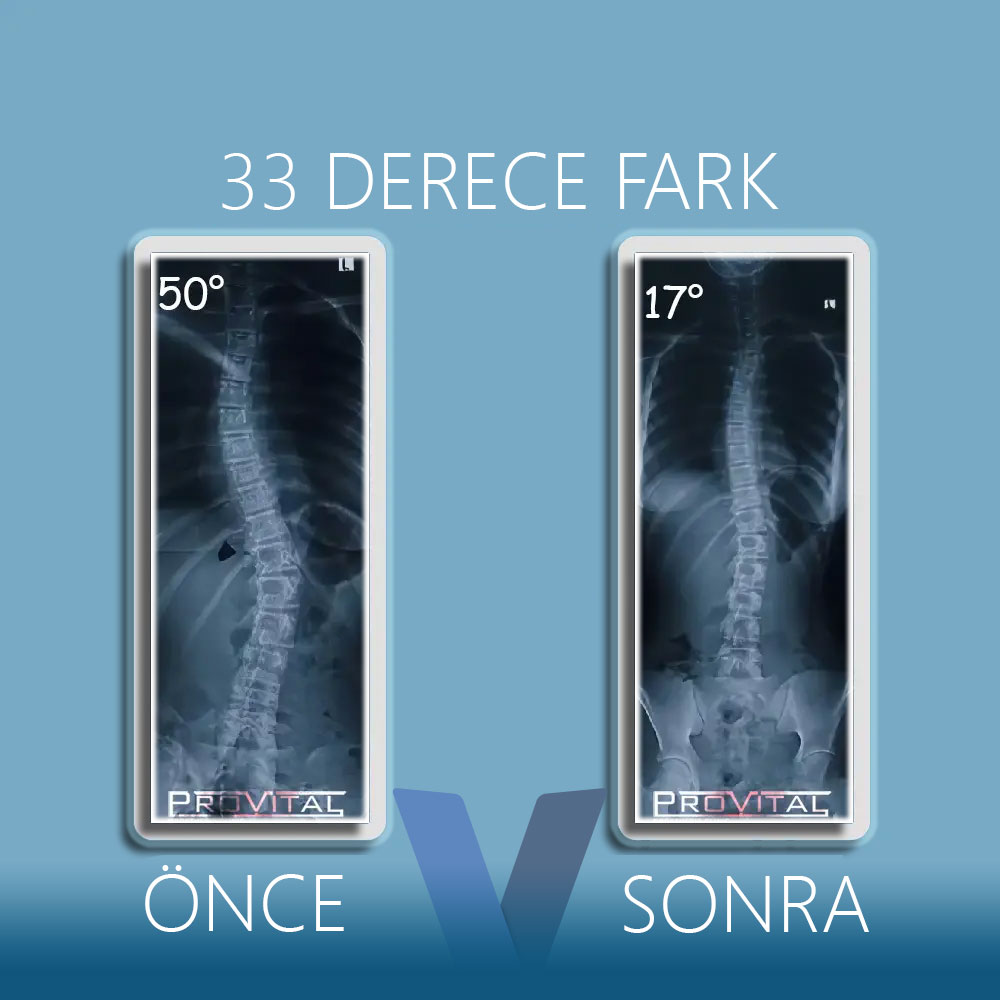 Skolyoz Korsesi Fiyatları (2025) (Skolyoz Tedavisi) 27 skolyoz-korsesi-işe-yarıyor-mu