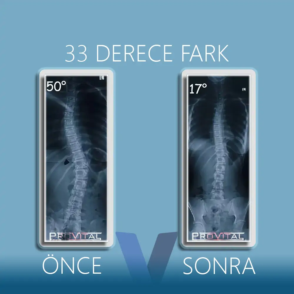 Skolyoz Korsesi (Ameliyatsız Skolyoz Tedavisi) 59 skolyoz-korsesi-işe-yarıyor-mu