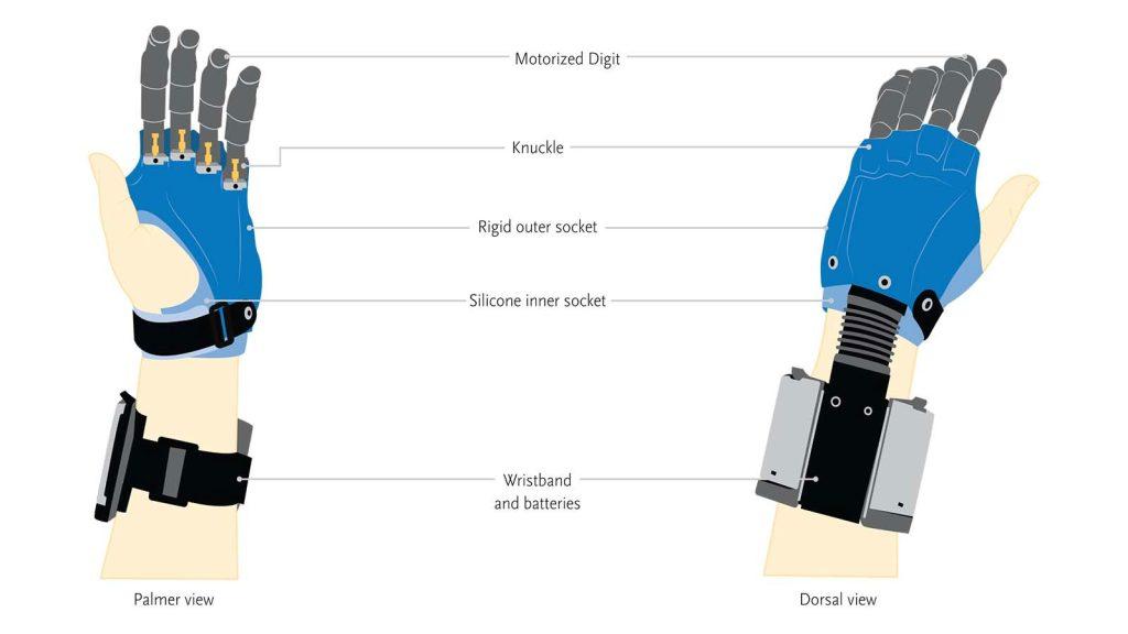i digits prosthetics