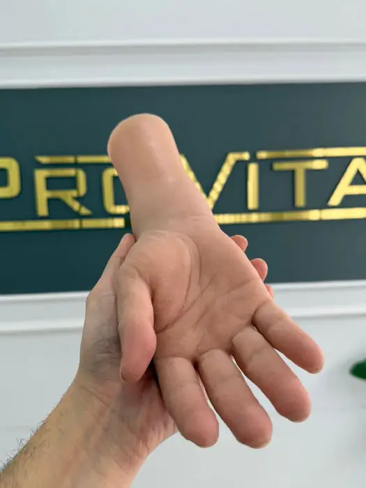 Silikon Protez Çeşitleri- El, Ayak, Parmak 39 silikon-protez